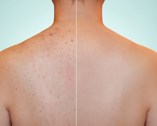 לפני ואחרי טיפול בצלקות אקנה בגב